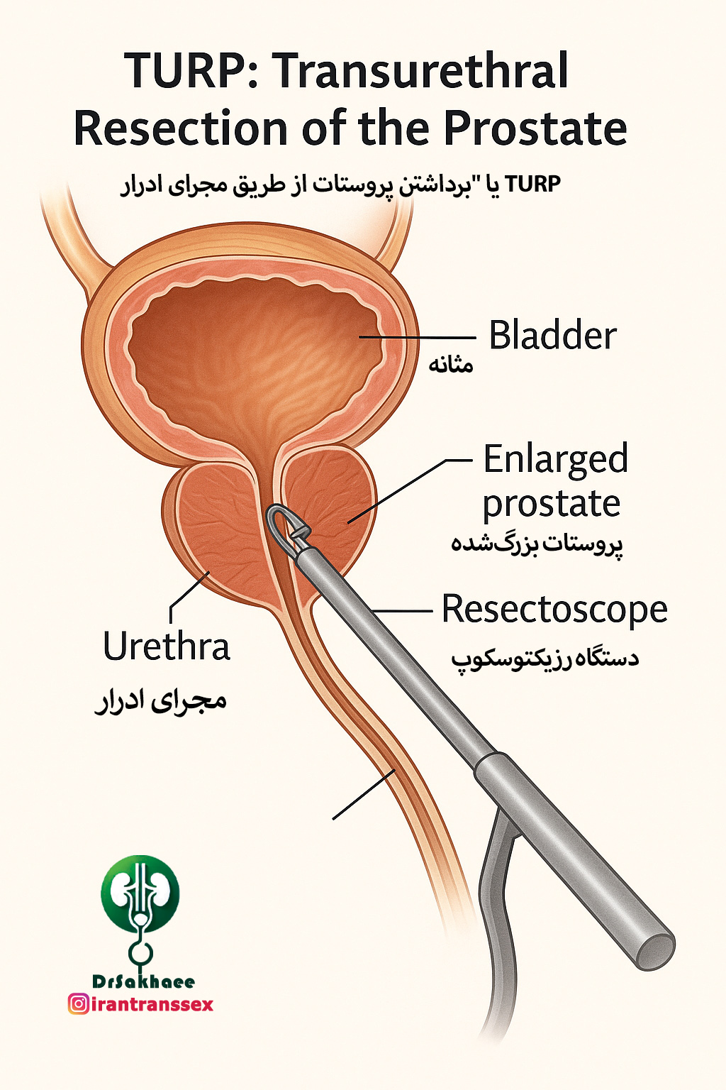 برش پیشمثانهای